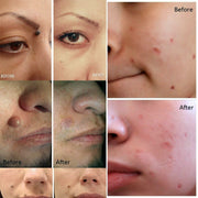 Electric Laser Plasma Pen Mole Removal Dark Spot Remover Skin Wart Tag Tattoo